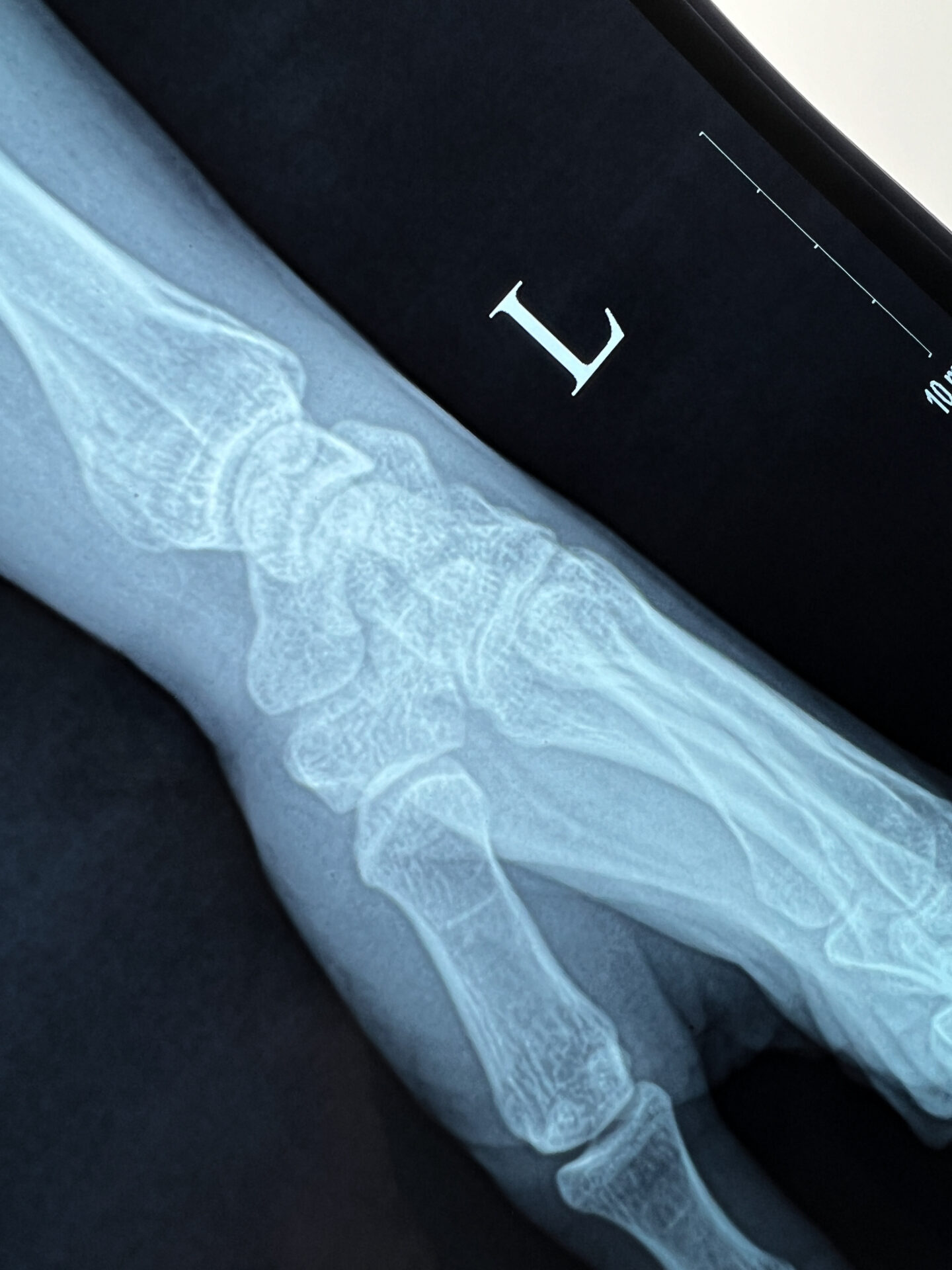 Wrist x-ray alternate view